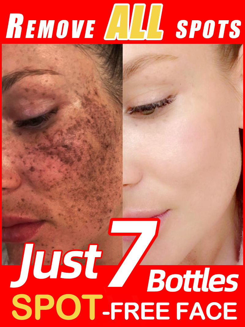 Luxury Natural Skincare - Verlicht sproeten Melasma, donkere gezichtsvlekken